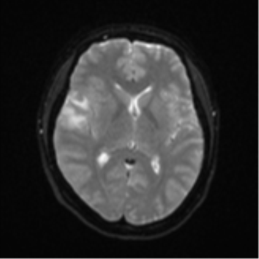 File:Anaplastic astroblastoma (Radiopaedia 55666-62194 Axial DWI 15).png