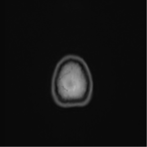 Anaplastic astroblastoma (Radiopaedia 55666-62194 Axial T1 75).png