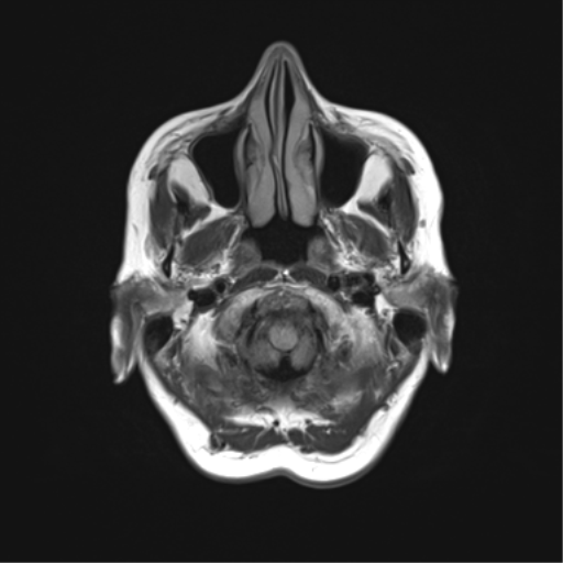 File:Anaplastic astrocytoma (Radiopaedia 86943-103160 Axial FLAIR 3).png