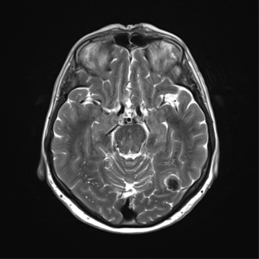 File:Anaplastic astrocytoma (Radiopaedia 86943-103160 Axial T2 16).png