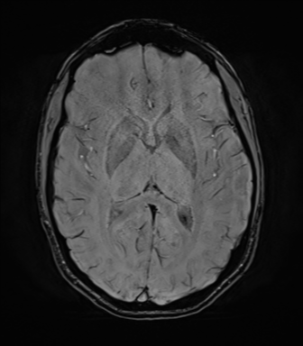File:Anaplastic astrocytoma IDH mutant (Radiopaedia 50046-55341 Axial SWI 46).png