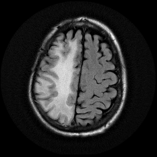 File:Anaplastic meningioma with recurrence (Radiopaedia 34452-35790 Axial T2 FLAIR 17).png