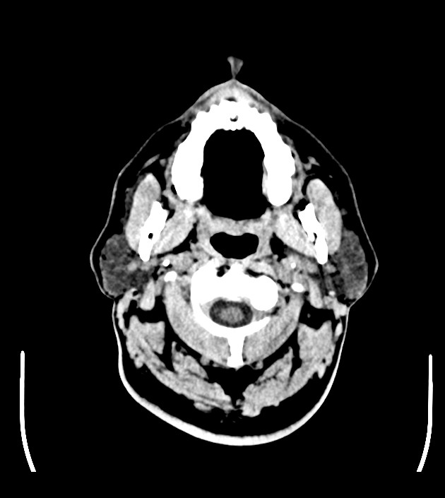 Anaplastic oligodendroglioma (Radiopaedia 79571-92753 Axial non-contrast 1).jpg