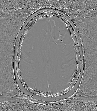 Anaplastic oligodendroglioma (Radiopaedia 83500-98599 Axial SWI - phase 62).png