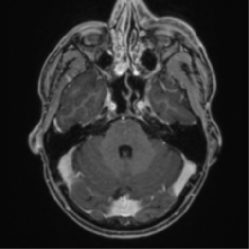Anaplastic oligodendroglioma with skull fracture (Radiopaedia 74831-85845 Axial T1 C+ fat sat 14).png