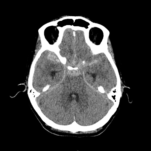 Aneursym related subarachnoid hemorrhage with hydrocephalus (Radiopaedia 45105-49083 Axial non-contrast 13).jpg