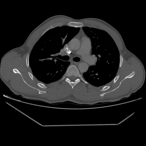 Aneurysmal bone cyst - rib (Radiopaedia 82167-96220 Axial bone window 114).jpg