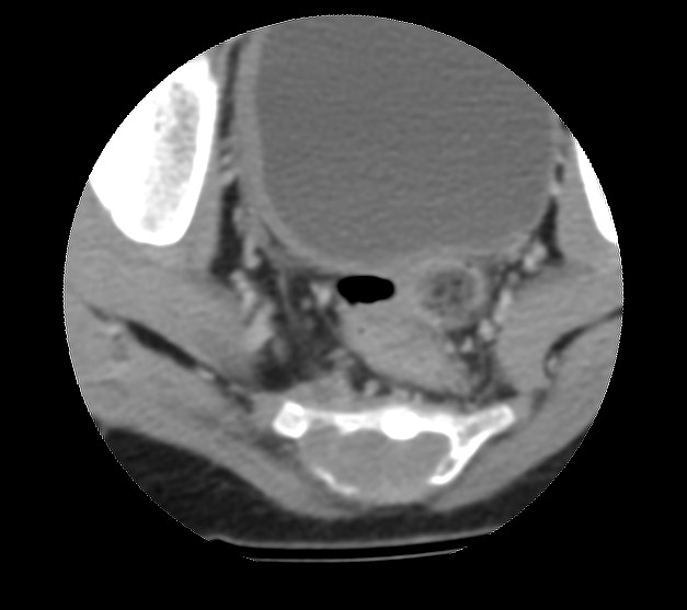 Aneurysmal bone cyst - sacrum (Radiopaedia 65190-74195 Axial non-contrast 37).jpg
