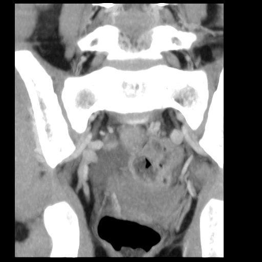 File:Aneurysmal bone cyst - sacrum (Radiopaedia 65190-74195 D 3).jpg