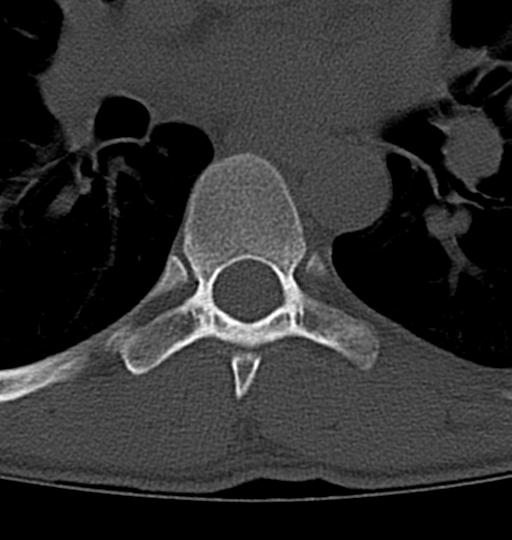Aneurysmal bone cyst T11 (Radiopaedia 29294-29721 Axial bone window 4).jpg