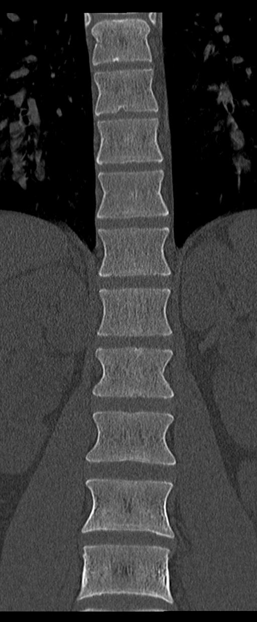 Aneurysmal bone cyst T11 (Radiopaedia 29294-29721 Coronal bone window 26).jpg