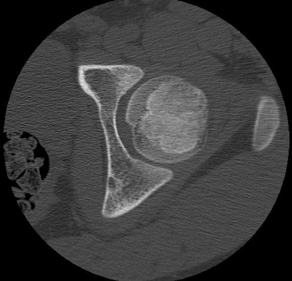 Aneurysmal bone cyst of ischium (Radiopaedia 25957-26094 B 10).png