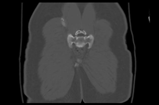 File:Aneurysmal bone cyst of ischium (Radiopaedia 25957-26094 Coronal bone window 43).png