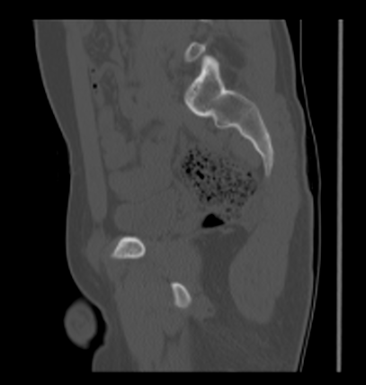 Aneurysmal bone cyst of ischium (Radiopaedia 25957-26094 Sagittal bone window 31).png
