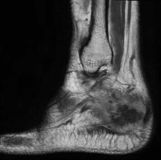 File:Aneurysmal bone cyst of the calcaneus (Radiopaedia 60669-68420 Sagittal T1 3).jpg