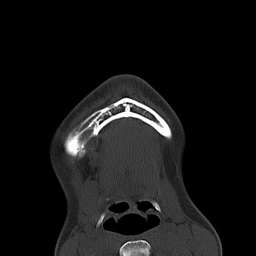 File:Aneurysmal bone cyst of the mandible (Radiopaedia 43280-46601 Axial bone window 3).jpg