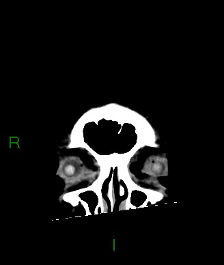 Aneurysmal subarachnoid hemorrhage with intra-axial extension (Radiopaedia 84371-99699 Coronal non-contrast 62).jpg