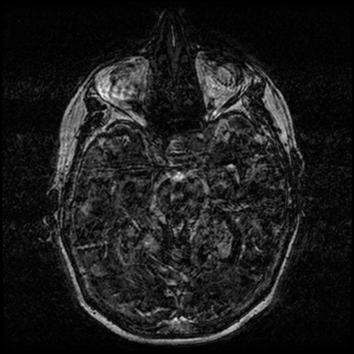 Angioinvasive aspergillosis in the pituitary fossa (Radiopaedia 39676-42010 Ax 3D FIESTA VOLUME 50).png