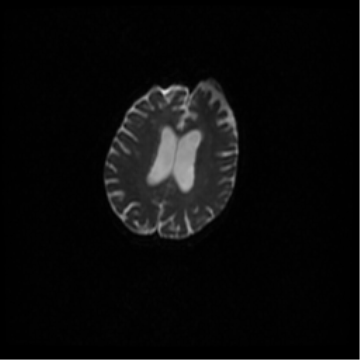 Angioinvasive aspergillosis in the pituitary fossa (Radiopaedia 39676-42010 Axial DWI 63).png