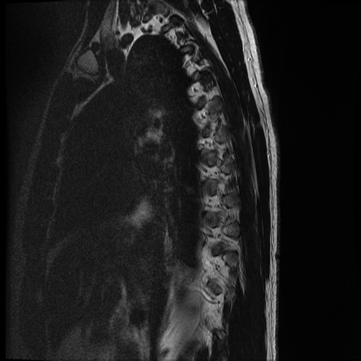 File:Angiolipoma - thoracic spine (Radiopaedia 28242-28479 Sagittal T2 14).jpg