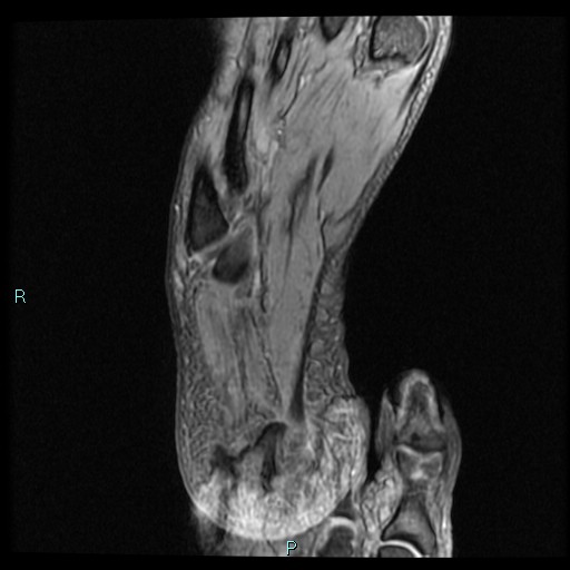 Ankle ganglion cyst (Radiopaedia 62809-71162 Axial Gradient Echo 1).jpg