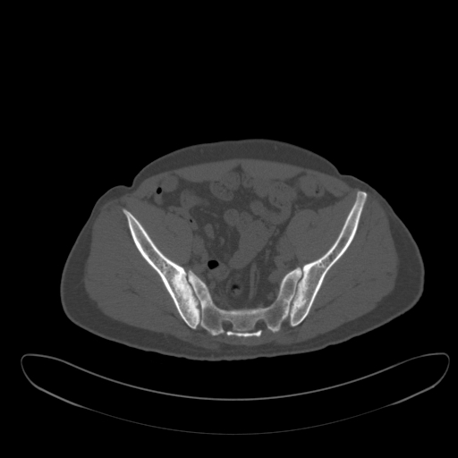 File:Ankylosing spondylitis (Radiopaedia 52728-58645 Axial bone window 41).jpg