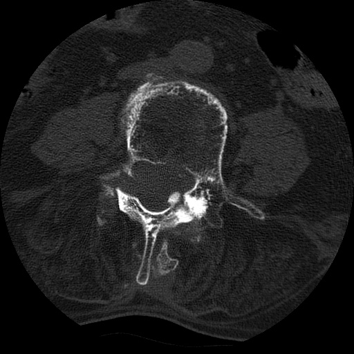 Ankylosing spondylitis complicated by fracture-dislocation (Radiopaedia 33583-34674 Axial non-contrast 100).jpg