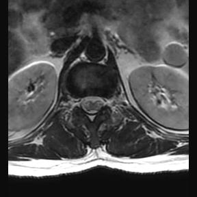 File:Ankylosing spondylitis with zygapophyseal arthritis (Radiopaedia 38433-40516 Axial T2 22).jpg