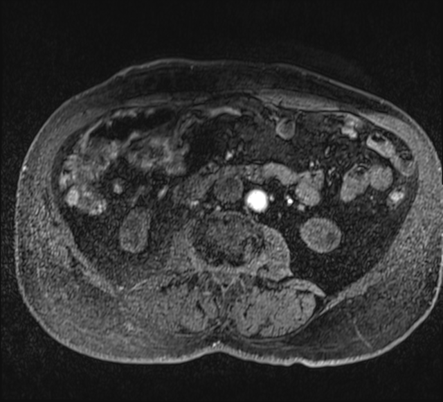 Annular pancreas (Radiopaedia 38292-40320 Axial T1 fat sat 68).png