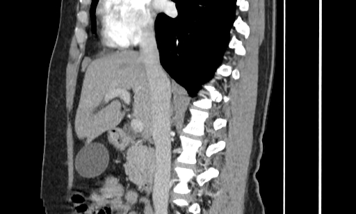 Annular pancreas (Radiopaedia 70359-80453 B 28).jpg