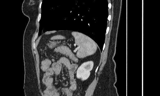 Annular pancreas (Radiopaedia 70359-80453 B 51).jpg