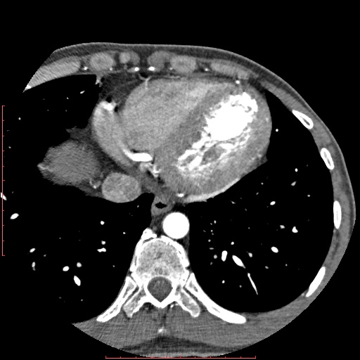 File:Anomalous left coronary artery from the pulmonary artery (ALCAPA) (Radiopaedia 70148-80181 A 302).jpg