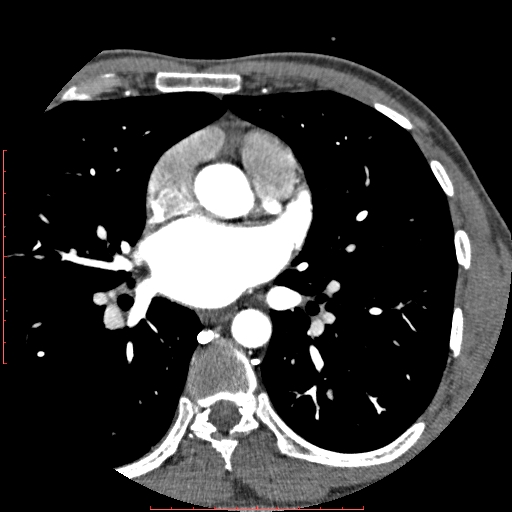 Anomalous left coronary artery from the pulmonary artery (ALCAPA) (Radiopaedia 70148-80181 A 97).jpg