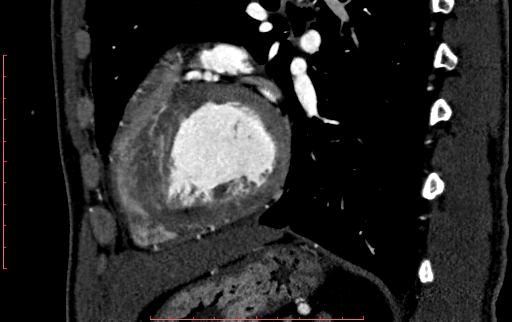 File:Anomalous left coronary artery from the pulmonary artery (ALCAPA) (Radiopaedia 70148-80181 C 176).jpg