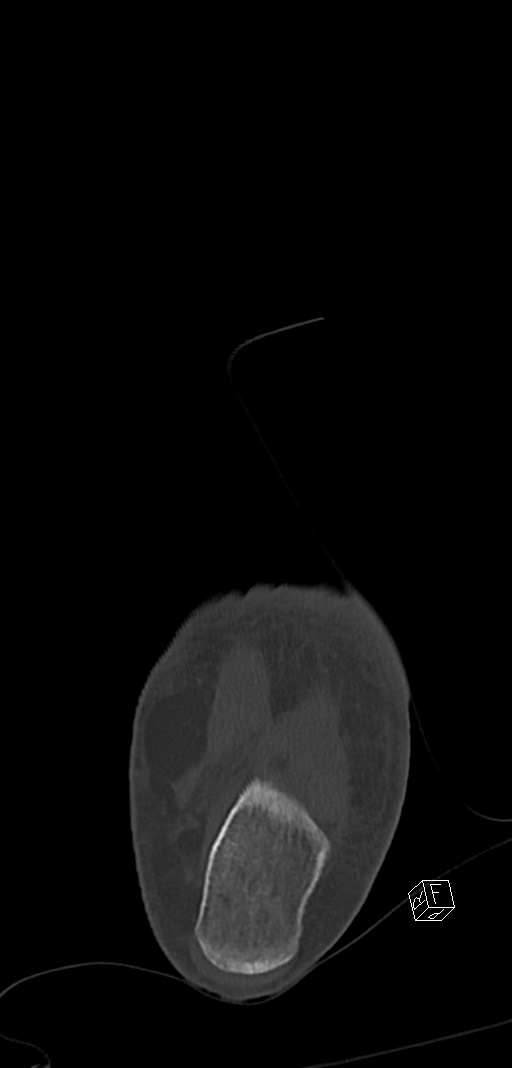 Anterior calcaneal process fracture (Radiopaedia 63353-71943 Coronal bone window 44).jpg