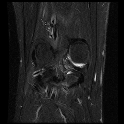 File:Anterior cruciate ligament avulsion fracture (Radiopaedia 58939-66193 Coronal STIR 15).jpg