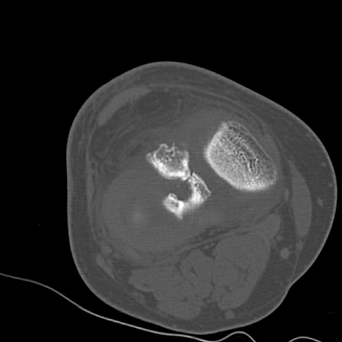 File:Anterior cruciate ligament avulsion fracture (Radiopaedia 58939-66194 Axial bone window 14).jpg