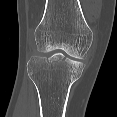 File:Anterior cruciate ligament avulsion fracture (Radiopaedia 58939-66194 Coronal bone window 12).jpg