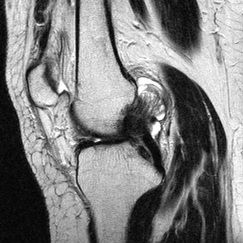 File:Anterior cruciate ligament mucoid degeneration (Radiopaedia 60853-68633 Sagittal T2 14).jpg