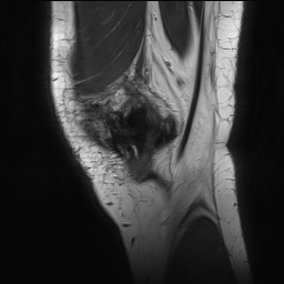 Anterior cruciate ligament rupture with Segond fracture (Radiopaedia 69043-78806 Sagittal PD 25).jpg