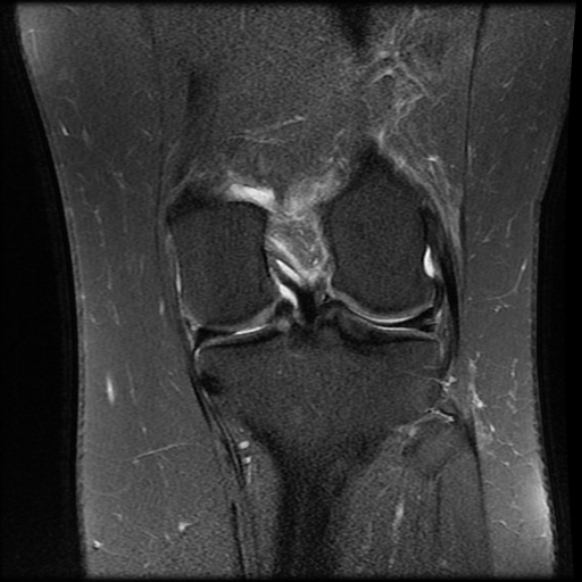 File:Anterior cruciate ligament tear, Wrisberg rip and bucket-handle tear of medial meniscus (Radiopaedia 75872-87266 Coronal PD fat sat 18).jpg