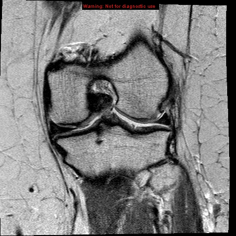 File:Anterior cruciate ligament tear (Radiopaedia 12329-12612 Coronal PD 14).jpg