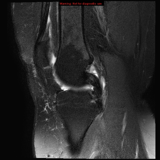 File:Anterior cruciate ligament tear - complete (Radiopaedia 12175-12514 Sagittal T2 fat sat 13).jpg