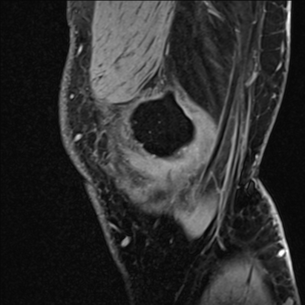 Anterior cruciate ligament tear - ramp lesion (Radiopaedia 71883-82322 Sagittal T1 vibe 123).jpg