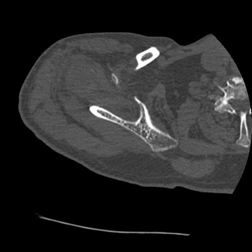 Anterior glenohumeral dislocation with Hill-Sachs lesion (Radiopaedia 62877-71249 Axial bone window 22).jpg
