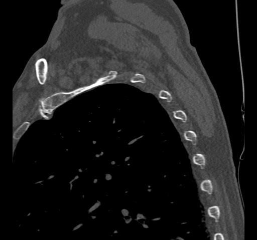 Anterior glenohumeral dislocation with Hill-Sachs lesion (Radiopaedia 62877-71249 Sagittal bone window 62).jpg