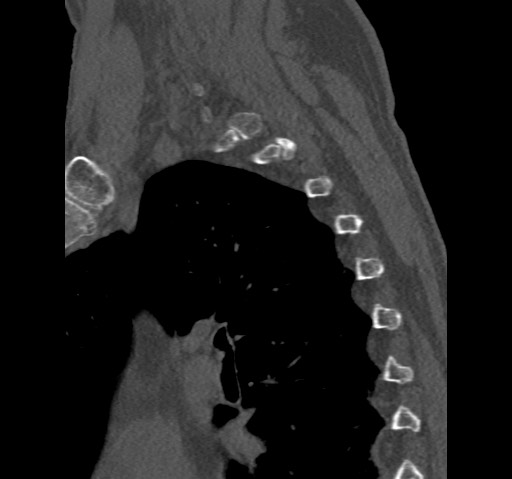 Anterior glenohumeral dislocation with Hill-Sachs lesion (Radiopaedia 62877-71249 Sagittal bone window 72).jpg
