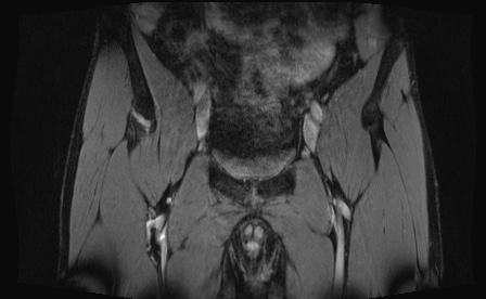 Anterior inferior iliac spine avulsion fracture (Radiopaedia 81312-95000 G 81).jpg