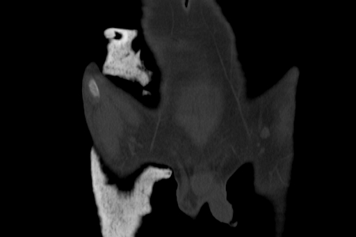 Anterior inferior iliac spine avulsion injury (Radiopaedia 88666-105376 Coronal bone window 10).jpg