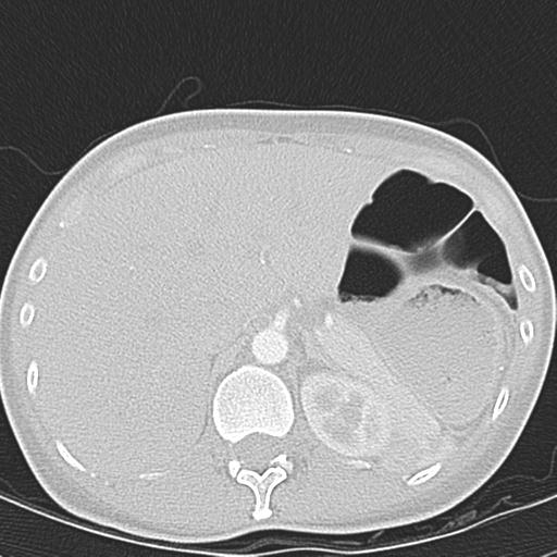 Anterior mediastinal lymphoma (Radiopaedia 29556-30061 Axial lung window 55).jpg